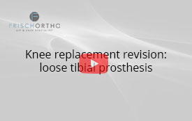 Knee replacement revision: loose tibial prosthesis